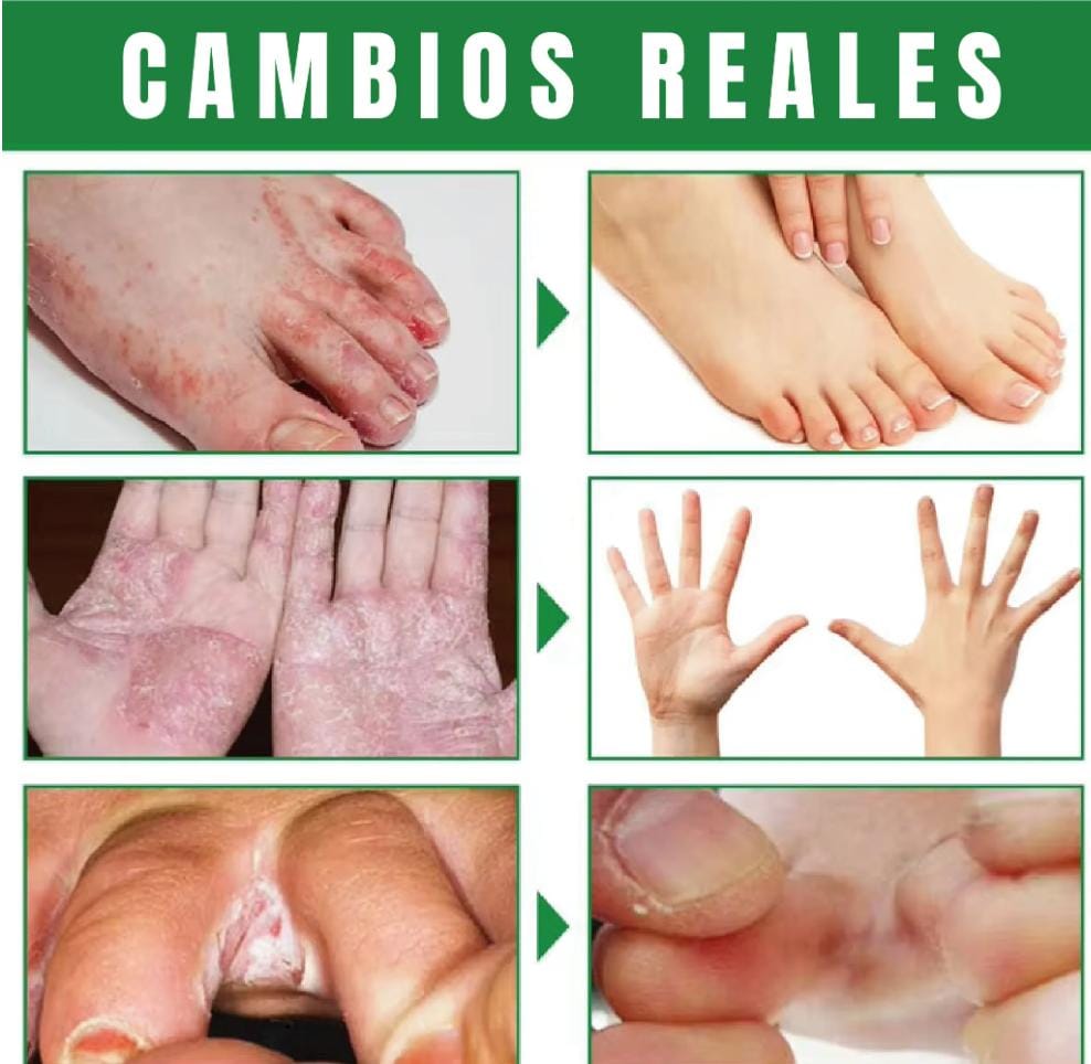 Spray Eliminador de Hongos