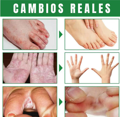 Spray Eliminador de Hongos